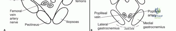 صورة توضيحية لـ تحسين استئصال ساركوما الفراغات: دليل شامل للنهج الجراحية مع الأستاذ الدكتور محمد هطيف