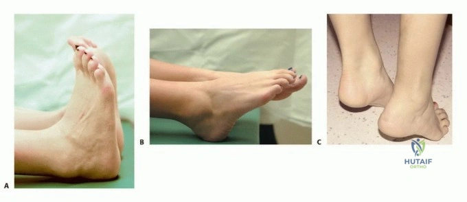صورة طبية: استئصال ورم العضلة النعلية: دليل شامل لحماية عضلة الساق والتعافي الكامل في صنعاء مع الأستاذ الدكتور محمد هطيف