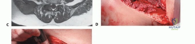 صورة توضيحية لـ جراحة نقائل الحوض: حل شامل لآلام العظام واستعادة الحركة مع الأستاذ الدكتور محمد هطيف