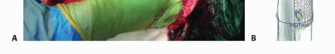 صورة طبية: وحدة إكستر للورك: إتقان تطعيم العظام بالضغط لمعالجة فقدان عظم الفخذ في صنعاء مع الأستاذ الدكتور محمد هطيف
