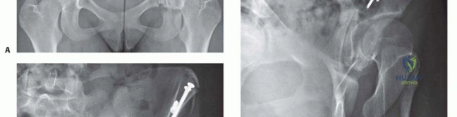 صورة طبية: استعادة صحة مفصل الفخذ جراحة قطع العظم الحوضي لعلاج خلل التنسج الحُقّي في صنعاء