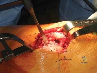 صورة طبية: استبدال مفصل الورك الكلي الناجح في خلل التنسج النمائي للورك: دليل شامل من الأستاذ الدكتور محمد هطيف