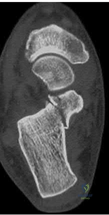 صورة طبية: دليل شامل لكسور وإصابات الجهاز الحركي: رعاية متقدمة في صنعاء مع الأستاذ الدكتور محمد هطيف
