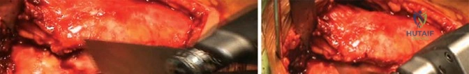 صورة توضيحية لـ استبدال مفصل الورك الكلي لتصلب المفصل العظمي: حلول لاستعادة الحركة مع الأستاذ الدكتور محمد هطيف