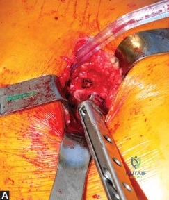 صورة طبية: استبدال مفصل الورك الكلي في العيادات الخارجية: دليل شامل من الأستاذ الدكتور محمد هطيف في صنعاء