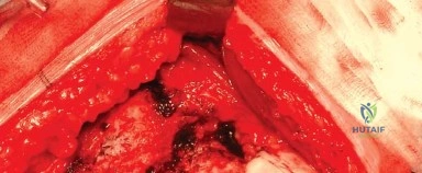 صورة طبية: المدخل الخلفي الجانبي لجراحة استبدال مفصل الورك الكلي: دليل شامل للمرضى في صنعاء مع الأستاذ الدكتور محمد هطيف