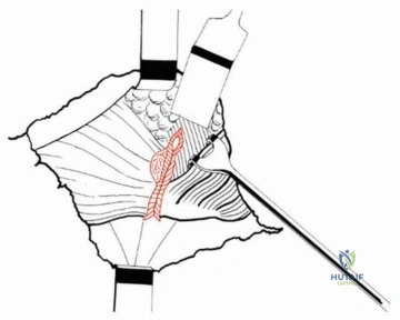 صورة طبية: قطع العظم المدوري الانزلاقي: دور حديث وتقنيات متطورة لاستعادة حركة الورك
