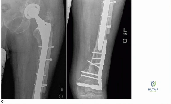 صورة طبية: إتقان مراجعة استبدال مفصل الورك: استراتيجيات تحديات الأنسجة المحلية الضارة