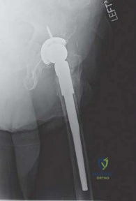صورة طبية: استبدال مفصل الورك لإنقاذ حالات فشل تثبيت كسور الورك: حل فعال لاستعادة الحركة