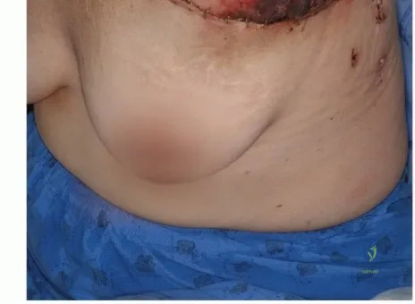 صورة طبية: بتر الربع الأمامي: كل ما يجب أن تعرفه عن هذا الإجراء المعقد