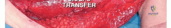 صورة طبية: استئصال ساركوما العضلة الرباعية مع الحفاظ على الطرف: دليل شامل للمرضى مع الأستاذ الدكتور محمد هطيف في صنعاء