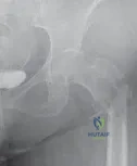 تفاصيل مرئية 23 - الخلاص من آلام سرطان العظام: استبدال مفصل الورك بالداني من الفخذ