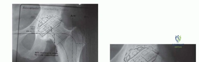 صورة توضيحية لـ استبدال مفصل الورك الكلي بالإسمنت الطبي: حل ناجح وموثوق لاستعادة الحركة