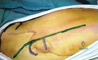 صورة توضيحية لـ قطع عظم المدور الكبير: حلول جراحية متقدمة لمشاكل مفصل الورك المعقدة