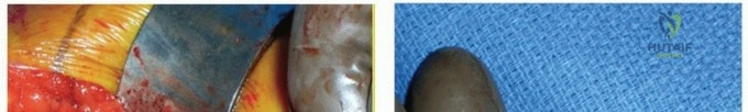 صورة توضيحية لـ مراجعة مفصل الورك: لماذا تتفوق الدعامات الأسطوانية المطلية بالمسام بشكل كامل؟