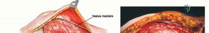 صورة طبية: النقائل العظمية الفخذية: دليل شامل للعلاج واستعادة الوظيفة مع الأستاذ الدكتور محمد هطيف في صنعاء