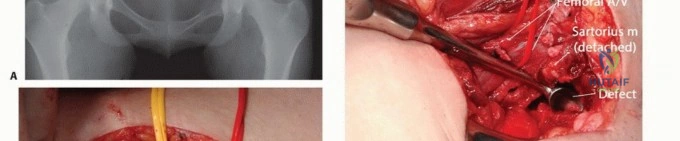 صورة توضيحية لـ جراحة نقائل الحوض: حل شامل لآلام العظام واستعادة الحركة مع الأستاذ الدكتور محمد هطيف