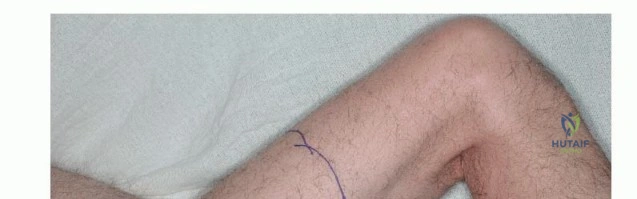 صورة طبية: استئصال ساركوما العضلة الرباعية مع الحفاظ على الطرف: دليل شامل للمرضى مع الأستاذ الدكتور محمد هطيف في صنعاء
