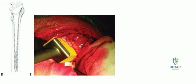 صورة طبية: وحدة إكستر للورك: إتقان تطعيم العظام بالضغط لمعالجة فقدان عظم الفخذ في صنعاء مع الأستاذ الدكتور محمد هطيف