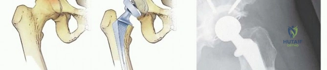 صورة توضيحية لـ استعادة الحركة بعد سرطان الورك: جراحة استبدال مفصل الورك الكلي للآفات الخبيثة مع الأستاذ الدكتور محمد هطيف في صنعاء