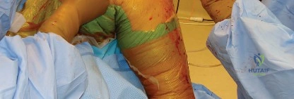 صورة شعاعية لحالة ناجحة