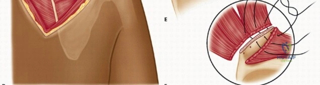 صورة طبية: متلازمة لوح الكتف الطقطقة الأسباب الأعراض والعلاج مع الأستاذ الدكتور محمد هطيف