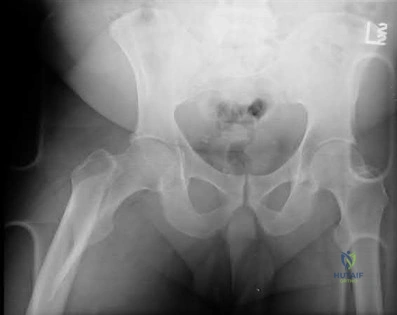 صورة طبية: دليل شامل لكسور وإصابات الجهاز الحركي: رعاية متقدمة في صنعاء مع الأستاذ الدكتور محمد هطيف