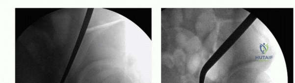 صورة توضيحية لـ جراحة قطع العظم حول الحُق وقطع عظم الفخذ: إعادة محاذاة مفصل الورك لراحة دائمة مع الأستاذ الدكتور محمد هطيف