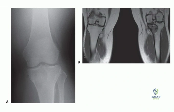 صورة توضيحية لـ كسور الكعبرة البعيدة المعقدة: دليل شامل للمرضى حول أحدث طرق العلاج مع الأستاذ الدكتور محمد هطيف