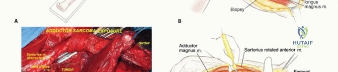 إغلاق الجرح التجميلي لتقليل الندبات