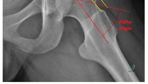 صورة توضيحية لـ استعادة صحة مفصل الفخذ جراحة قطع العظم الحوضي لعلاج خلل التنسج الحُقّي في صنعاء