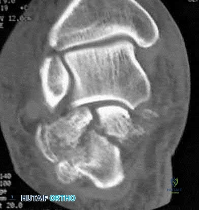 صورة طبية: دليل شامل لكسور وإصابات الجهاز الحركي: رعاية متقدمة في صنعاء مع الأستاذ الدكتور محمد هطيف