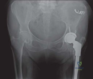 صورة طبية: استبدال مفصل الورك لإنقاذ حالات فشل تثبيت كسور الورك: حل فعال لاستعادة الحركة
