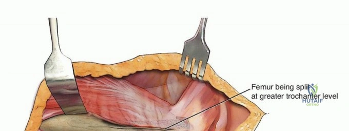 صورة توضيحية لـ مراجعة استبدال مفصل الورك الكلي: دقة إزالة المكونات الثابتة والحفاظ على العظم مع الأستاذ الدكتور محمد هطيف