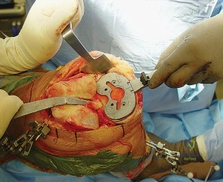 توضيح طبي: مقارنة بين الركبة الطبيعية والركبة التقوسية (Varus Knee) يظهر فيها توزيع الضغط غير المتوازن