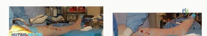 صورة توضيحية لـ نصف مفصل الورك: دليلك الشامل لدواعي الاستخدام والأنواع في صنعاء