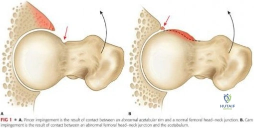 صورة توضيحية لـ الاحتكاك الفخذي الحقي: دليل شامل من الأستاذ الدكتور محمد هطيف في صنعاء