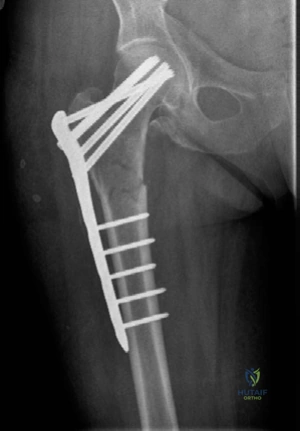 Illustration 6 for Lower Limb Trauma: Decipher Anteroposterior (AP) Figure for Exams