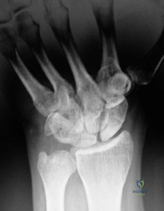 صورة بالأشعة المقطعية (CT Scan) للرسغ