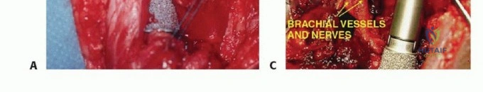 صورة طبية: استئصال الجزء القريب من عظم العضد بتقنيات الحفاظ على الطرف: دليل شامل للمرضى مع الأستاذ الدكتور محمد هطيف