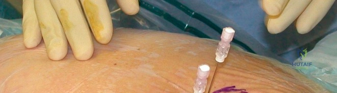 صورة طبية: منظار مفصل الفخذ: تقنيات أساسية ونتائج مثلى مع الأستاذ الدكتور محمد هطيف في صنعاء