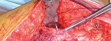 صورة توضيحية لـ جراحة مفصل الورك المراجعة: دليل شامل للنهج الجانبي المباشر لنتائج أفضل في صنعاء