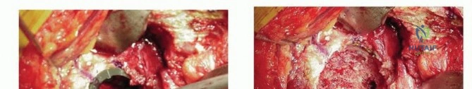 صورة طبية: استبدال مفصل الورك الكلي بالإسمنت الطبي: حل ناجح وموثوق لاستعادة الحركة