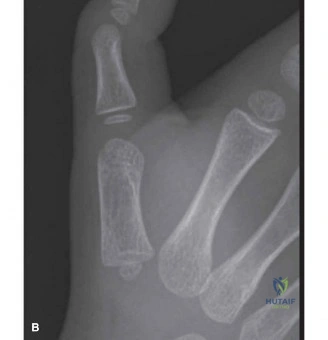 ساركوما العظام عند الأطفال: دليل شامل للعلاج الجراحي وإنقاذ الأطراف مع الأستاذ الدكتور محمد هطيف