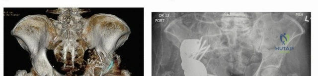 صورة طبية: إتقان مراجعة استبدال مفصل الورك: استراتيجيات تحديات الأنسجة المحلية الضارة
