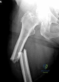 صورة طبية: دليل شامل لكسور وإصابات الجهاز الحركي: رعاية متقدمة في صنعاء مع الأستاذ الدكتور محمد هطيف