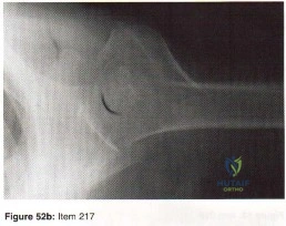 صورة طبية: دليلك الشامل لأمراض وإصابات العظام والمفاصل في اليمن: خبرة الأستاذ الدكتور محمد هطيف في صنعاء