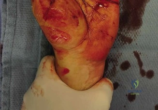 صورة توضيحية لـ إصابة العصب الكعبري السطحي: دليل شامل للتشخيص والعلاج مع الأستاذ الدكتور محمد هطيف في صنعاء