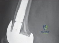 صورة طبية: إتقان موازنة الفجوة في مراجعة استبدال مفصل الركبة: تجنب الأخطاء الشائعة واستعادة الحركة مع الأستاذ الدكتور محمد هطيف