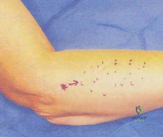 صورة طبية: آلام المرفق المعقدة: فهم وعلاج وتر الكاربوس الزندي القصير وغيرها من إصابات المرفق مع الأستاذ الدكتور محمد هطيف